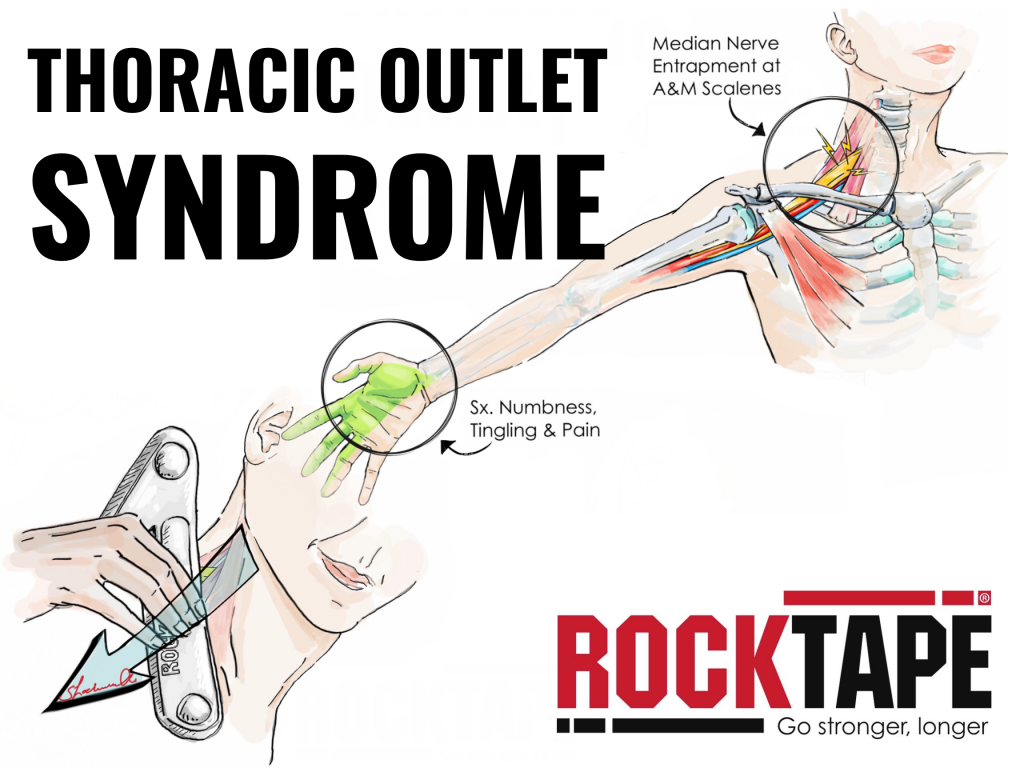 Thoracic Outlet Syndrome Anatomical Drawing
